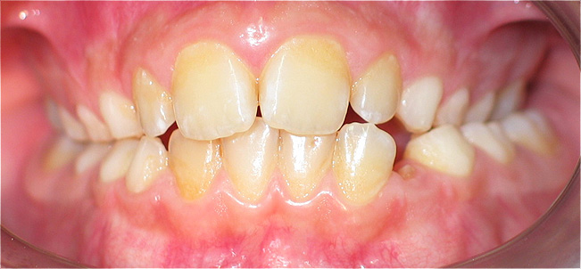tratamento ortod&ocirc;ntico em crian&ccedil;a