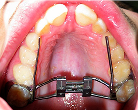 tratamento ortod&ocirc;ntico em crian&ccedil;a