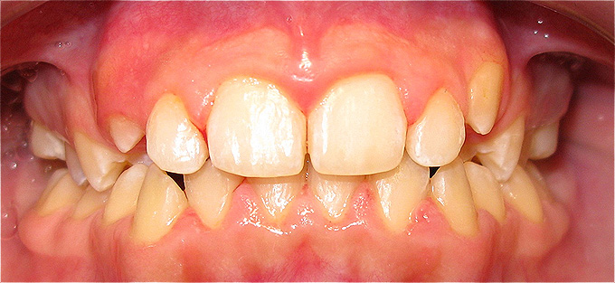 tratamento ortod&ocirc;ntico em crian&ccedil;a