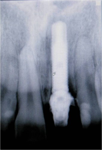 Dente 11