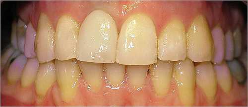 Coroa dent&aacute;ria ap&oacute;s a coloca&ccedil;&atilde;o implantes