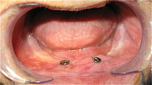 DESDENTADO TOTAL REABILITADO COM PR&Oacute;TESE ACRILICA REMOVIVEL INFERIOR, BARRA E CLIPS PARA RETEN&Ccedil;&Atilde;O E ESTABILIDADE