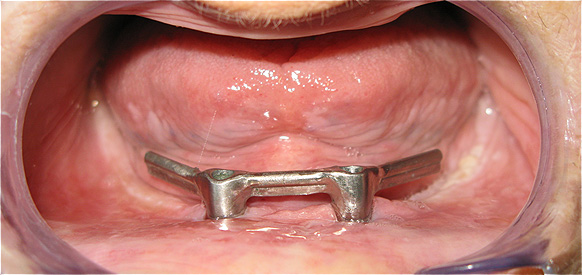 DESDENTADO TOTAL REABILITADO COM PR&Oacute;TESE ACRILICA REMOVIVEL INFERIOR, BARRA E CLIPS PARA RETEN&Ccedil;&Atilde;O E ESTABILIDADE