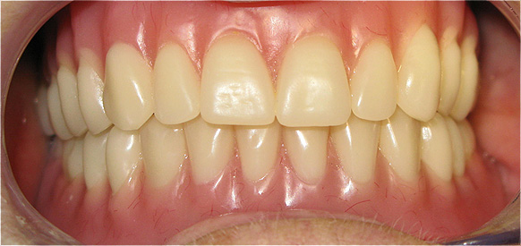 DESDENTADO TOTAL REABILITADO COM PR&Oacute;TESE ACRILICA REMOVIVEL INFERIOR, BARRA E CLIPS PARA RETEN&Ccedil;&Atilde;O E ESTABILIDADE