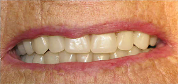 DESDENTADO TOTAL REABILITADO COM PR&Oacute;TESE ACRILICA REMOVIVEL INFERIOR, BARRA E CLIPS PARA RETEN&Ccedil;&Atilde;O E ESTABILIDADE