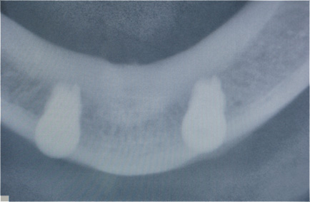 Implante dent&aacute;rio