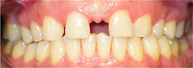 Agenesia dos incisivos laterais superiores - tratamento ortod&ocirc;ntico - implantes com coroas cer&acirc;micas para o 12 e 22
