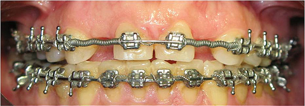 Agenesia dos incisivos laterais superiores - tratamento ortod&ocirc;ntico - implantes com coroas cer&acirc;micas para o 12 e 22