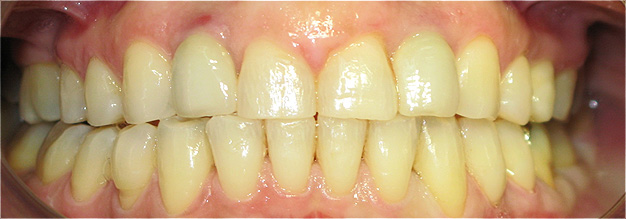 Agenesia dos incisivos laterais superiores - tratamento ortod&ocirc;ntico - implantes com coroas cer&acirc;micas para o 12 e 22