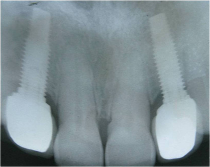 Agenesia dos incisivos laterais superiores - tratamento ortod&ocirc;ntico - implantes com coroas cer&acirc;micas para o 12 e 22