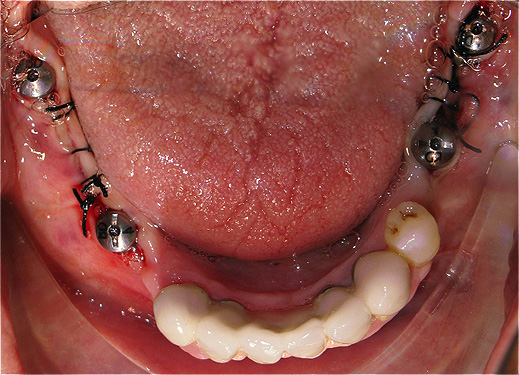 Implantes dent&aacute;rios