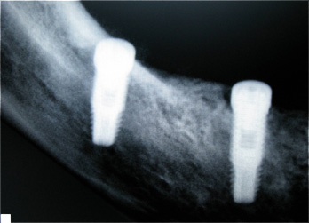 Implantes dent&aacute;rios