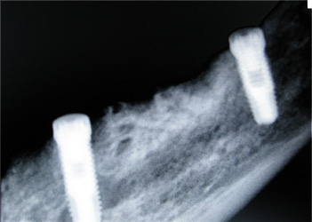 Implantes dent&aacute;rios