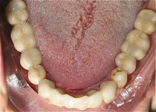 Implantes dent&aacute;rios
