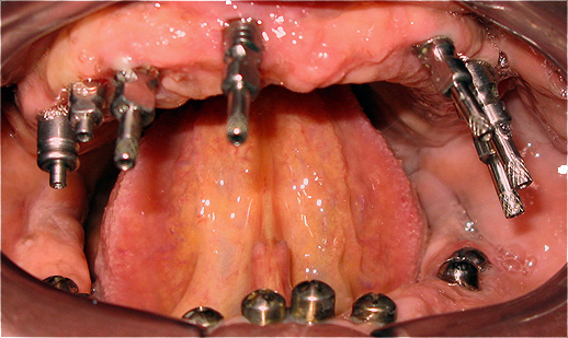 Implantes dent&aacute;rios