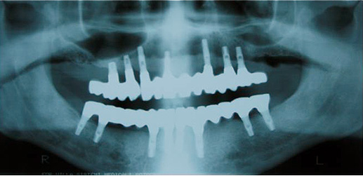 Implantes dent&aacute;rios