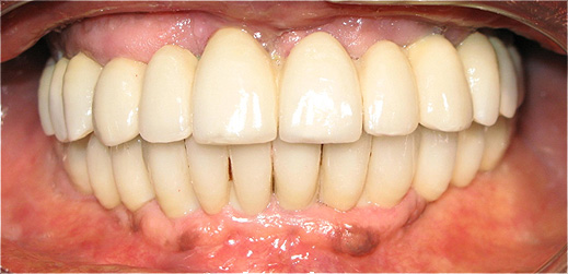 Implantes dent&aacute;rios