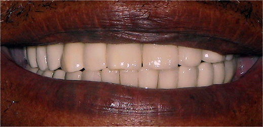 Implantes dent&aacute;rios