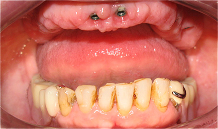 Implantes dent&aacute;rios