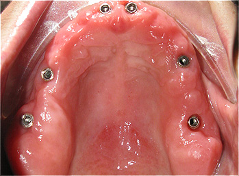 Implantes dent&aacute;rios
