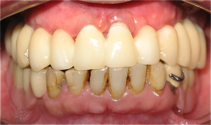 Implantes dent&aacute;rios