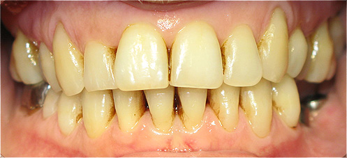Implantes dent&aacute;rios