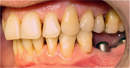 Implantes dent&aacute;rios