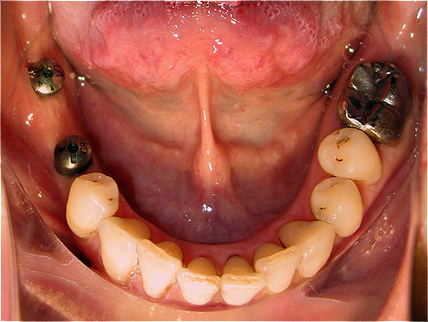 Implantes dent&aacute;rios