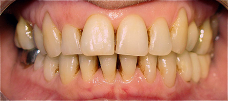 Implantes dent&aacute;rios