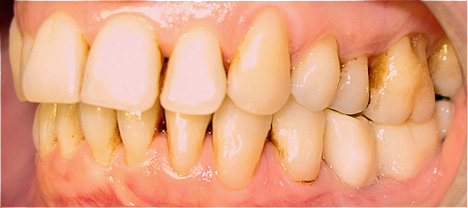 Implantes dent&aacute;rios