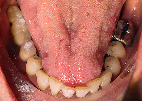 Implantes dent&aacute;rios